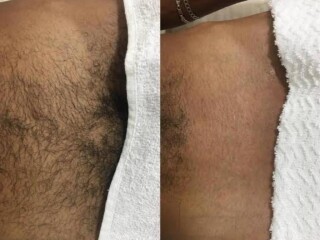 Depilaco ntima masculina maquina Bela Vista massagem e drenagem linftica no [***] 